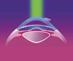 LASIK