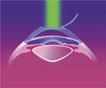 LASIK
