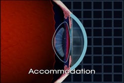 Presbyopia Presbyopia