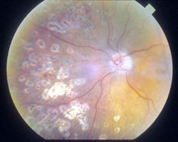 Pan Retinal Photocoagulation