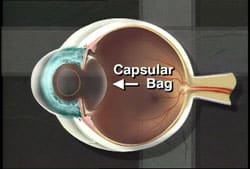 Capsular Bag 1