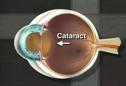 Cataracts in the Eye
