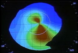 Corneal Topography