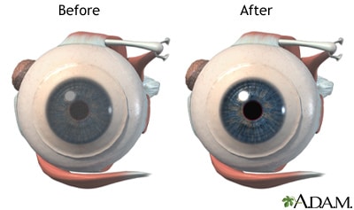 Fuchs Dystrophy img