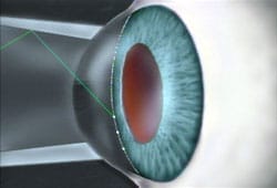 Glaucoma for Open Angle