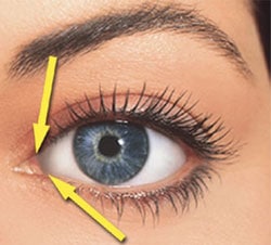 Punctal Occlusion