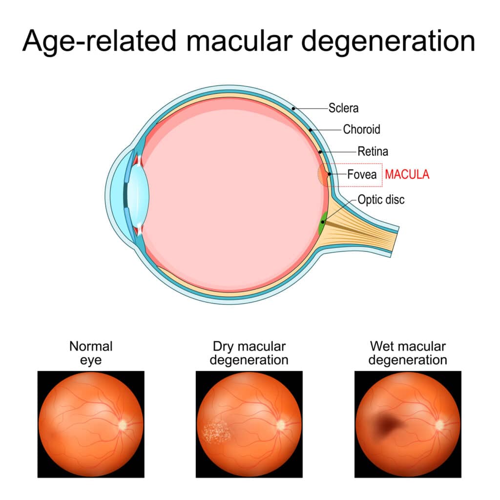 MACULAR DEGENERATION